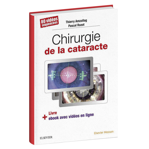 Chirurgie de la cataracte